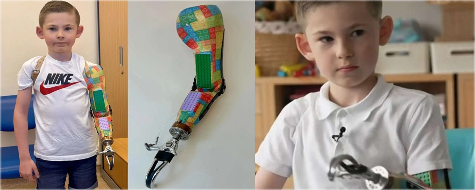 Menino ganha prótese de braço feita de Lego
