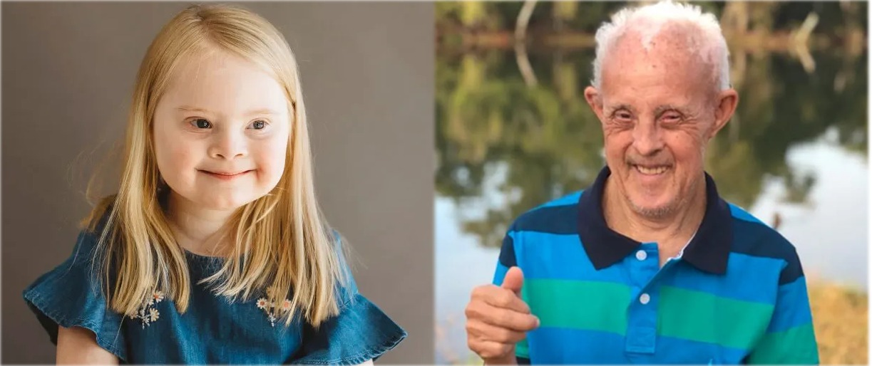 Expectativa de vida das pessoas com Síndrome de Down aumentou 400%