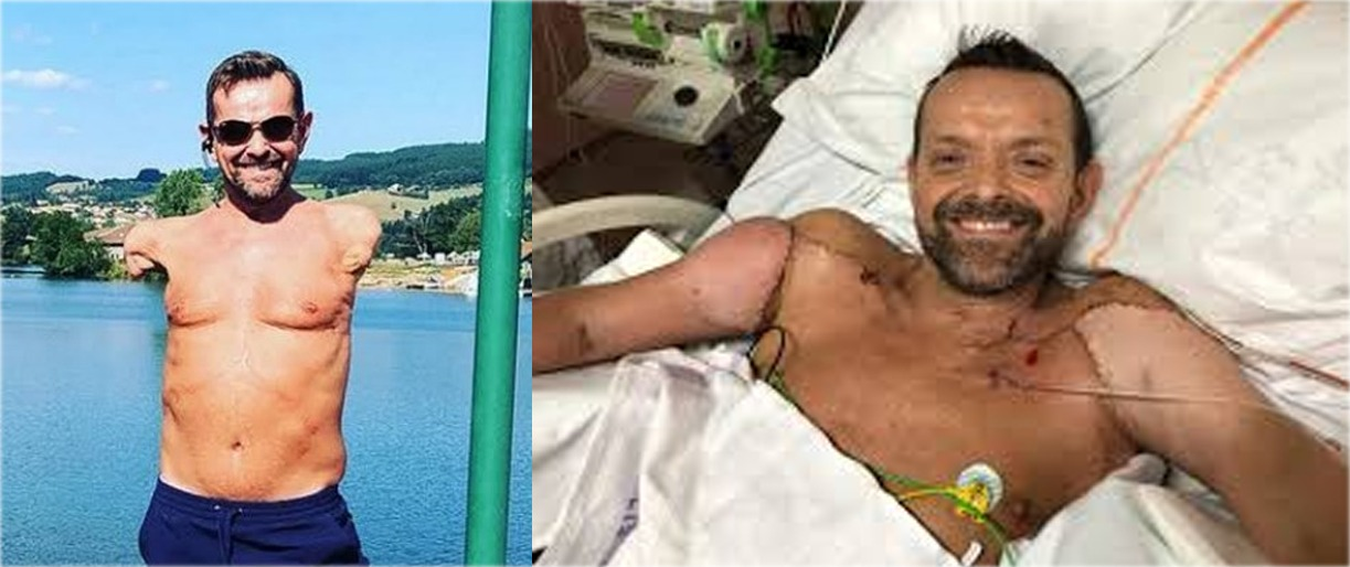 Islandês é 1º paciente do mundo com transplante duplo de braço e ombro