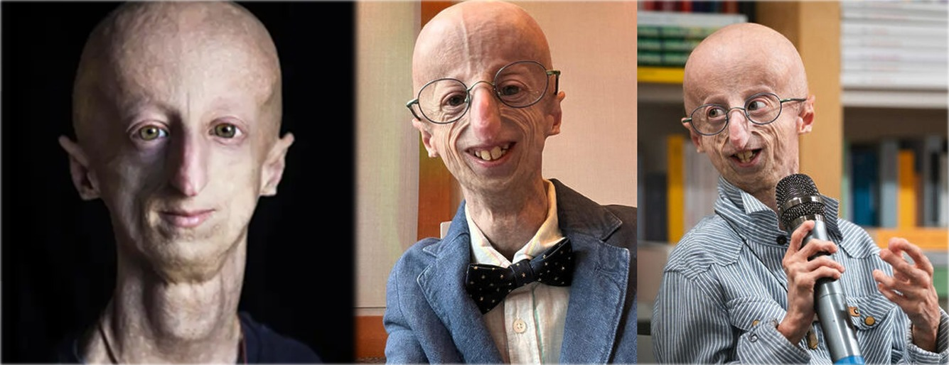 Jovem com progeria estudou para ajudar outros com a condição rara